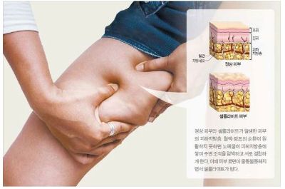 허벅지 울퉁불퉁한 피부 셀룰라이트 없애는 방법  